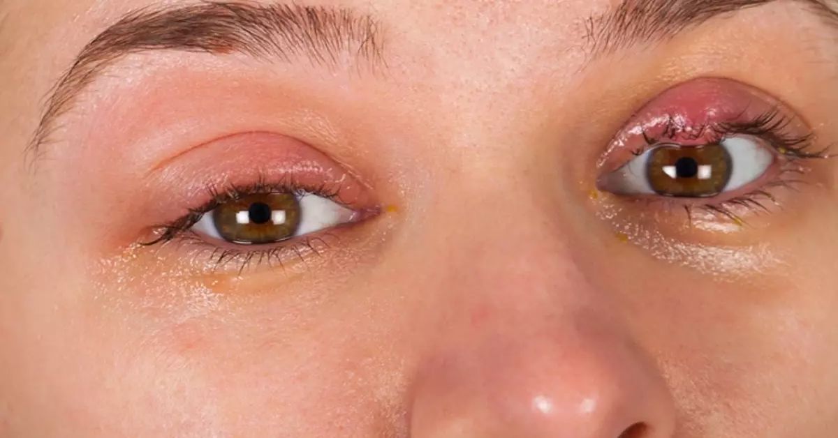 Göz Kapağı Şalazyon Ameliyatı