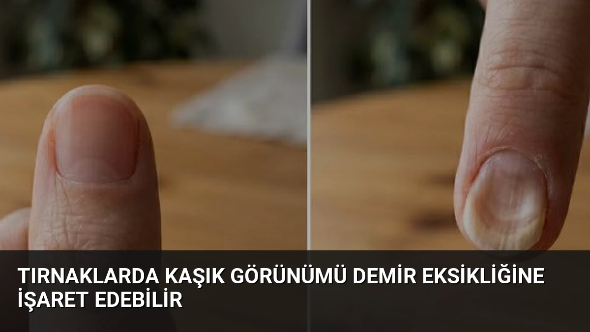 Tırnaklarda Kaşık Görünümü Demir Eksikliğine İşaret Edebilir