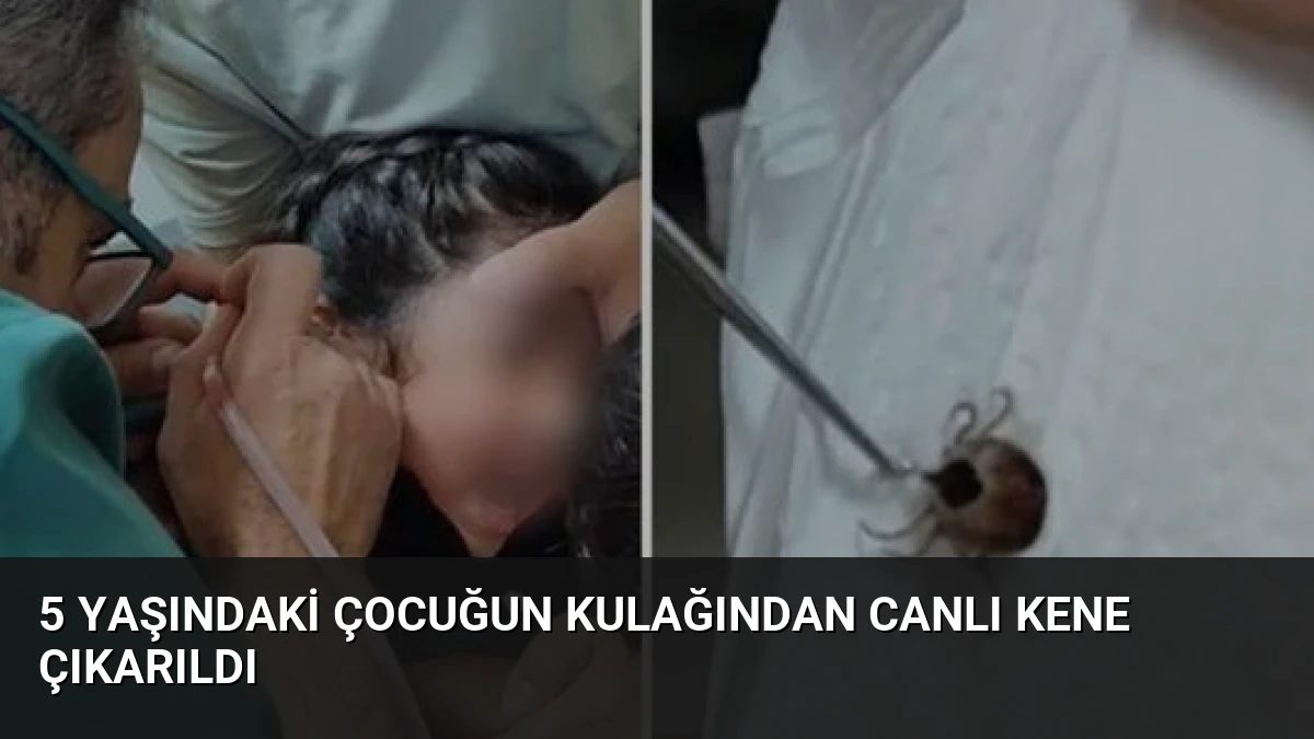 5 Yaşındaki Çocuğun Kulağından Canlı Kene Çıkarıldı