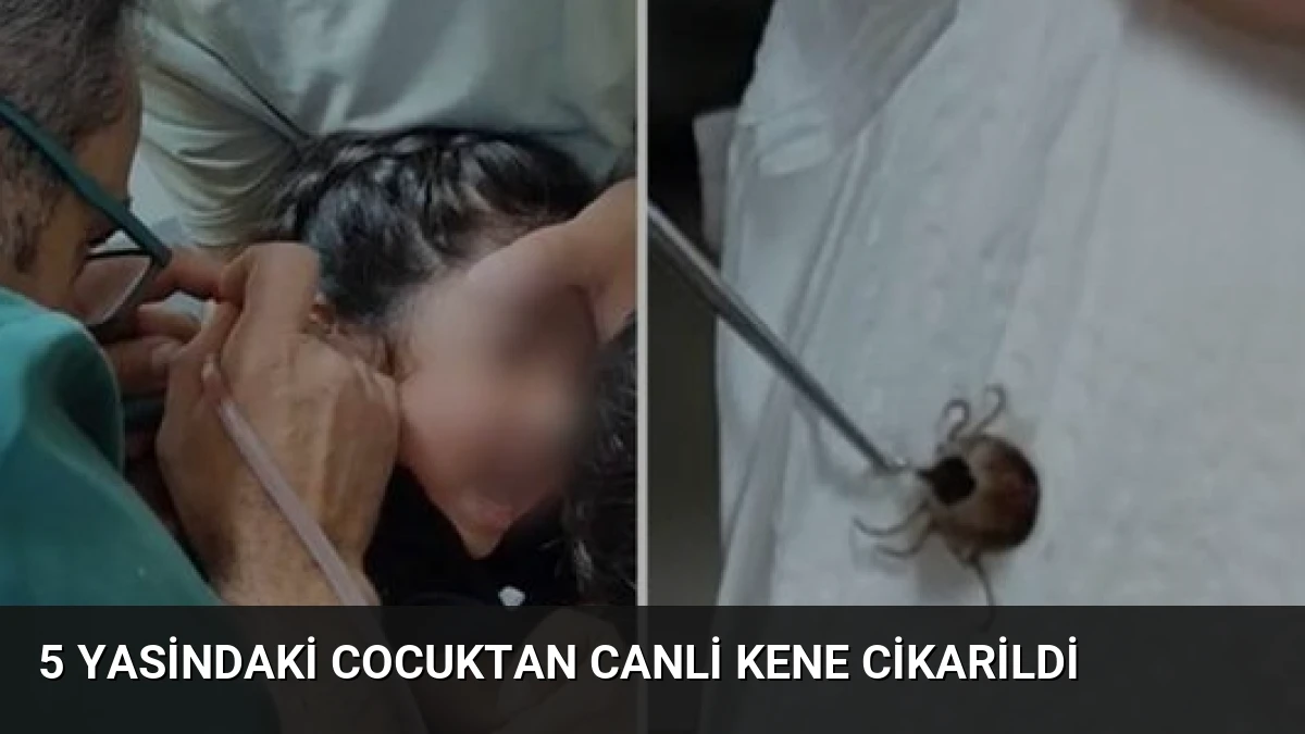 5 Yasindaki Cocuktan Canli Kene Cikarildi