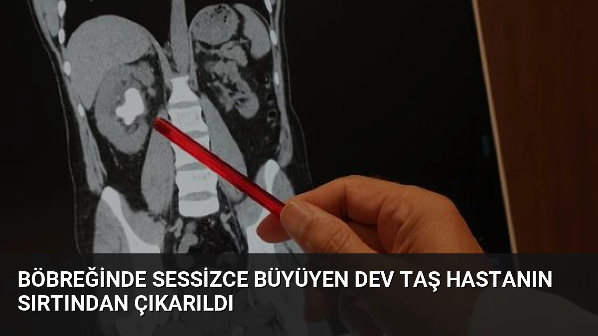 Böbreğinde Sessizce Büyüyen Dev Taş Hastanın Sırtından Çıkarıldı