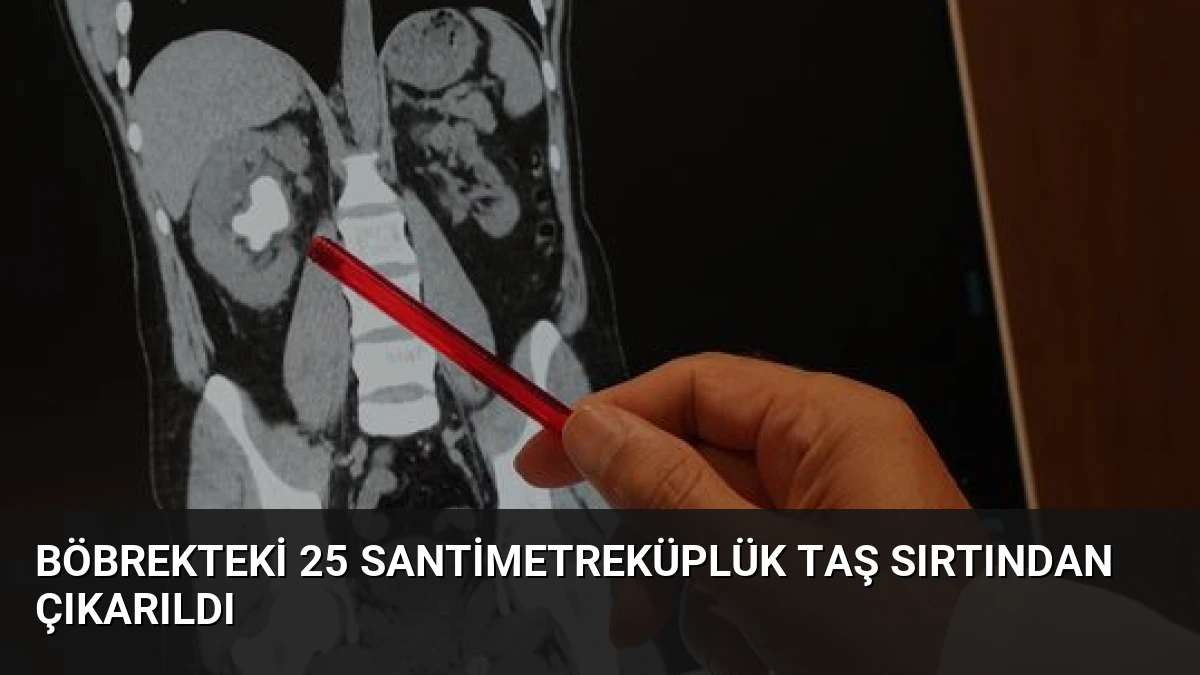 Böbrekteki 25 Santimetreküplük Taş Sırtından Çıkarıldı