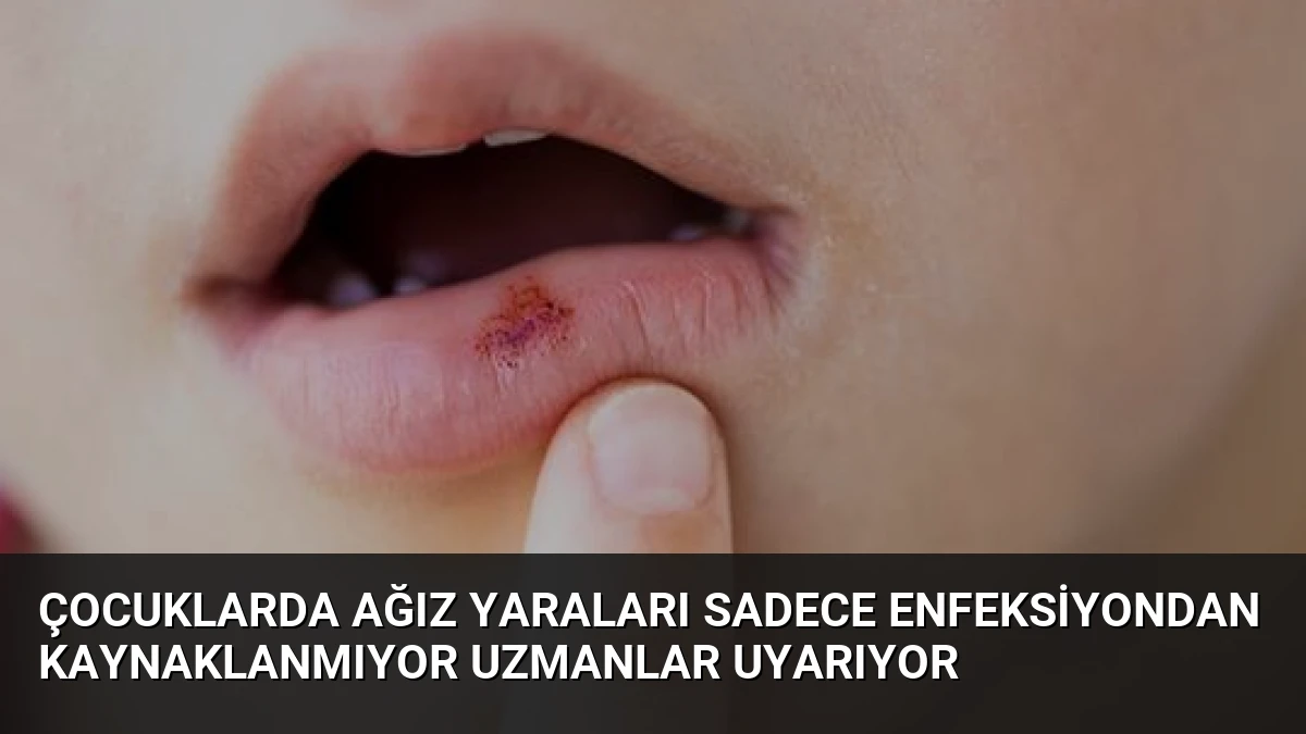 Çocuklarda Ağız Yaraları Sadece Enfeksiyondan Kaynaklanmıyor Uzmanlar Uyarıyor