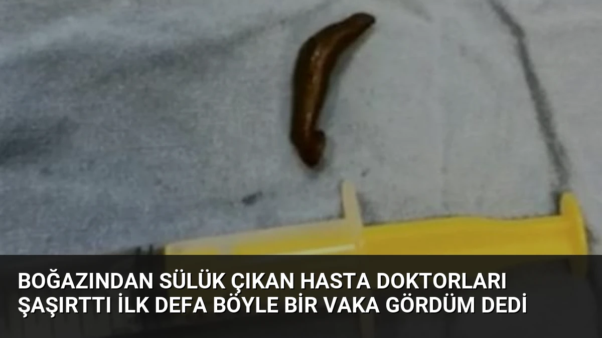 Boğazından Sülük Çıkan Hasta Doktorları Şaşırttı İlk Defa Böyle Bir Vaka Gördüm Dedi