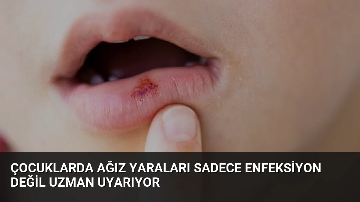Çocuklarda Ağız Yaraları Sadece Enfeksiyon Değil Uzman Uyarıyor