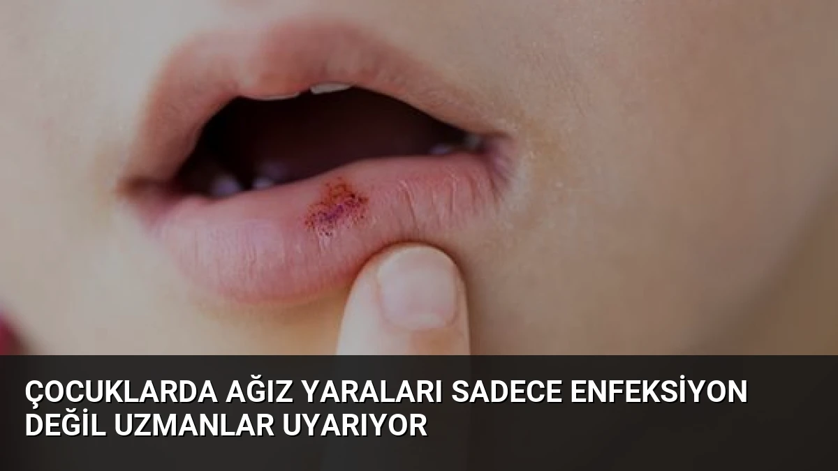 Çocuklarda Ağız Yaraları Sadece Enfeksiyon Değil Uzmanlar Uyarıyor