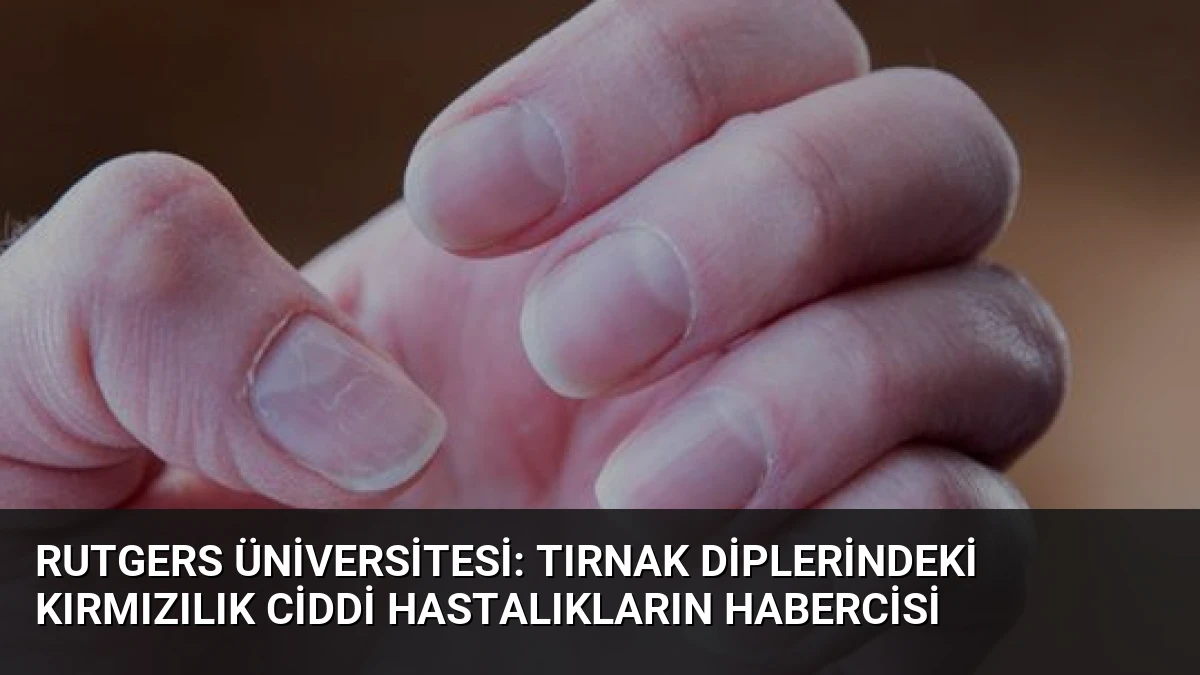 Rutgers Üniversitesi: Tırnak Diplerindeki Kırmızılık Ciddi Hastalıkların Habercisi