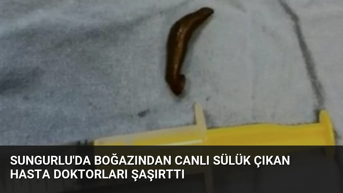 Sungurlu’da Boğazından Canlı Sülük Çıkan Hasta Doktorları Şaşırttı