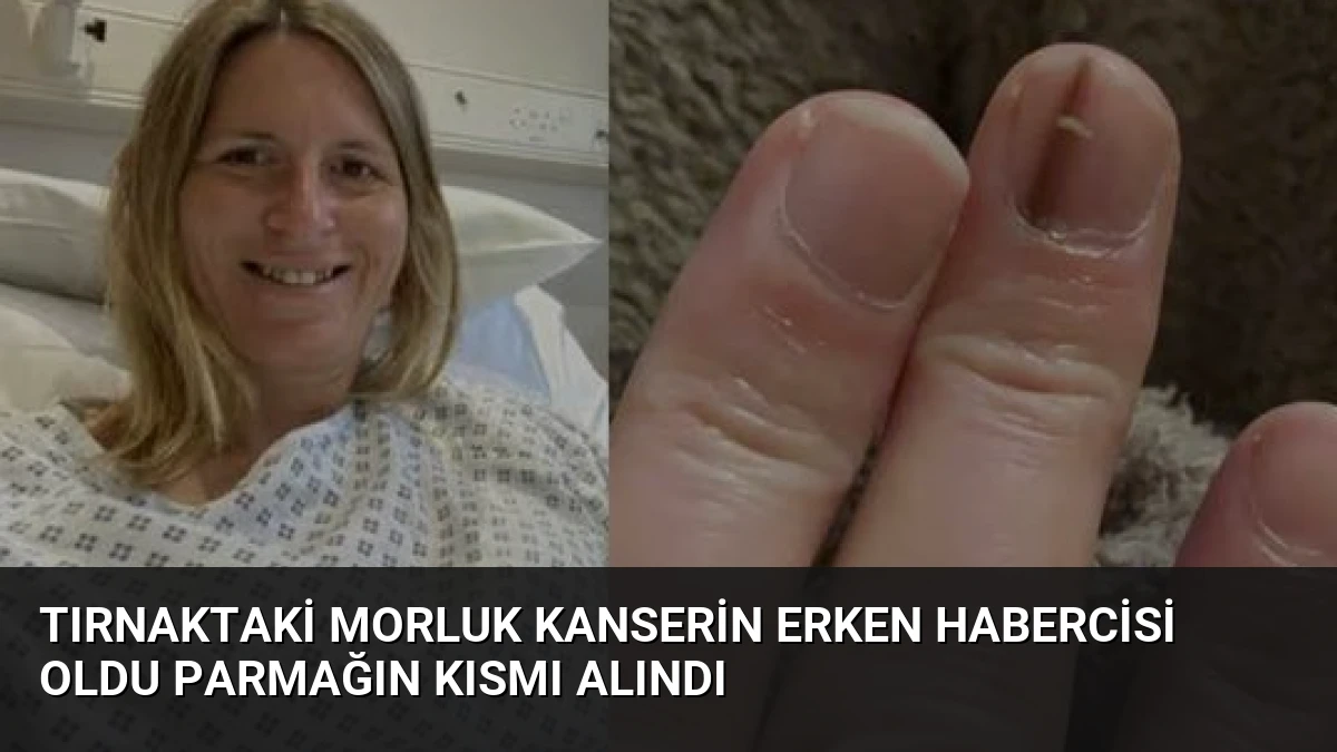 Tırnaktaki Morluk Kanserin Erken Habercisi Oldu Parmağın Kısmı Alındı