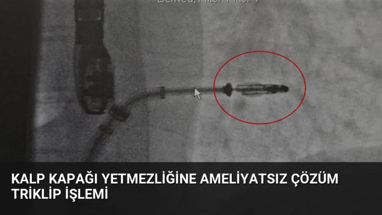 Kalp Kapağı Yetmezliğine Ameliyatsız Çözüm Triklip İşlemi
