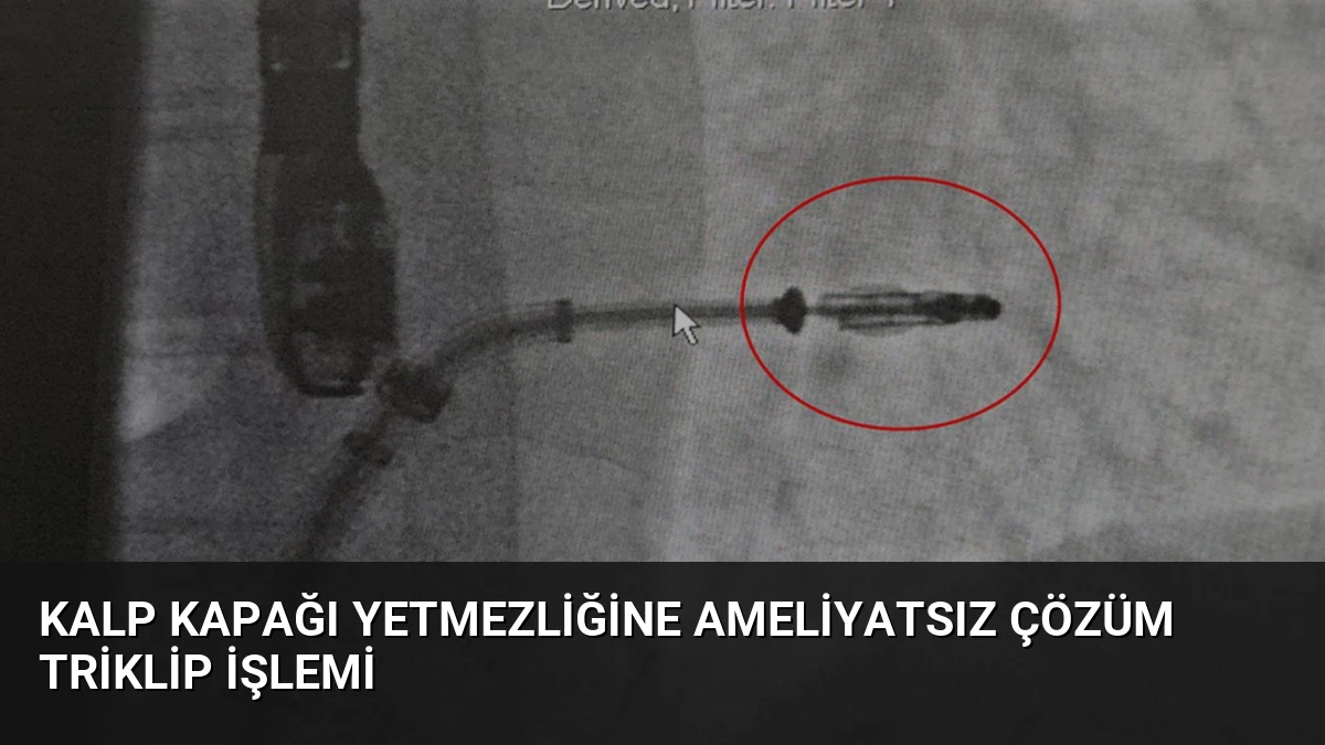 Kalp Kapağı Yetmezliğine Ameliyatsız Çözüm Triklip İşlemi