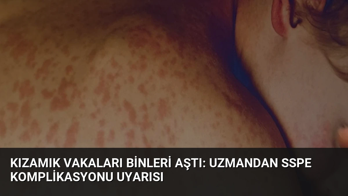 Kızamık Vakaları Binleri Aştı: Uzmandan SSPE Komplikasyonu Uyarısı