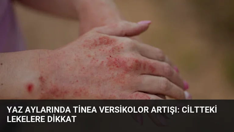 Yaz Aylarında Tinea Versikolor Artışı: Ciltteki Lekelere Dikkat