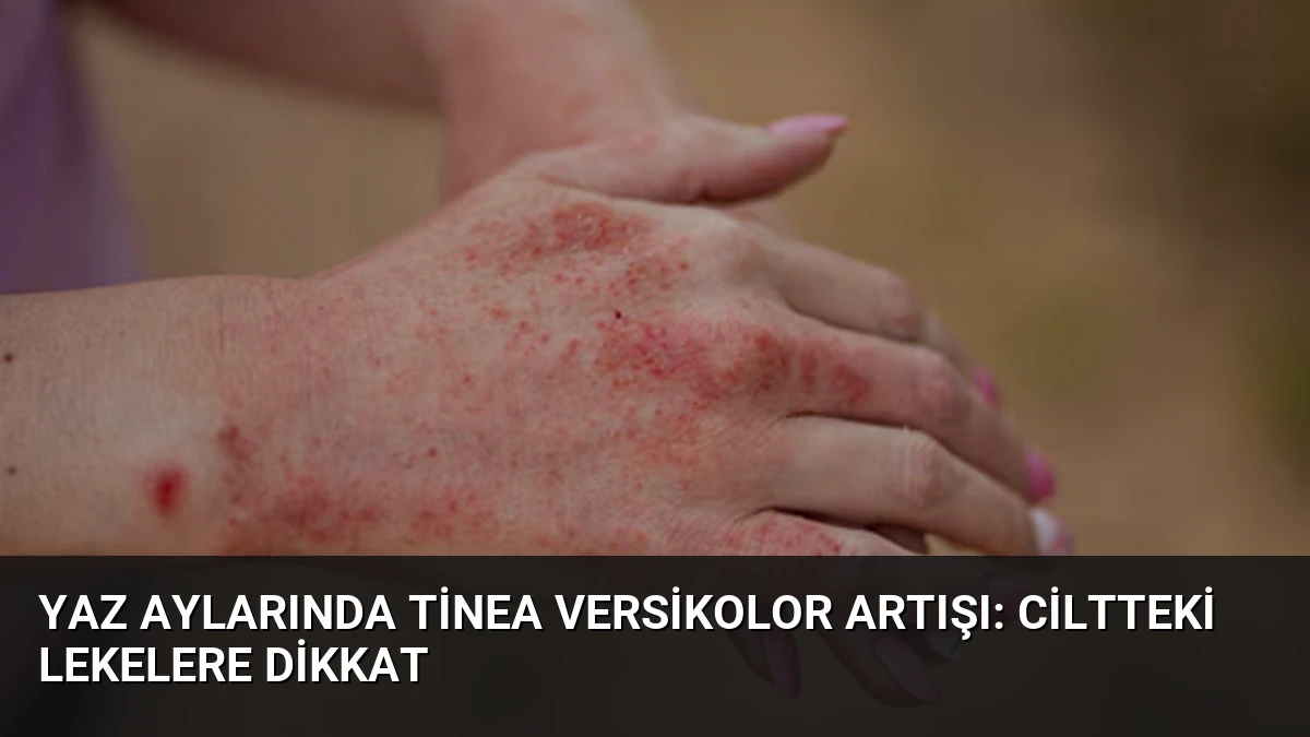 Yaz Aylarında Tinea Versikolor Artışı: Ciltteki Lekelere Dikkat